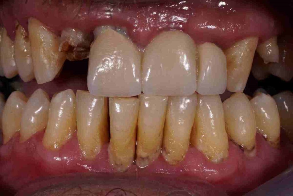Intraoral pic 1