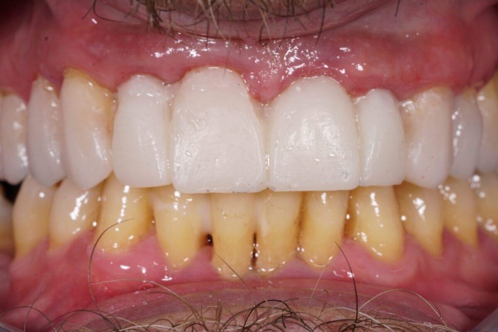 Intraoral pic of splinted 