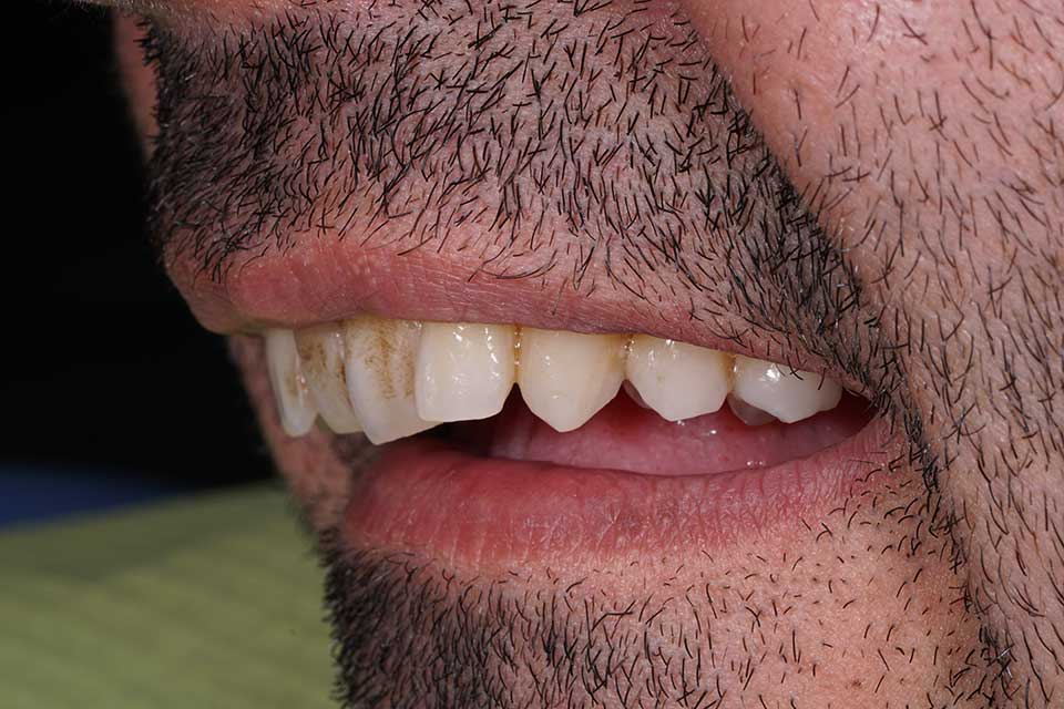3-prosthodontics-vs-orthodontics