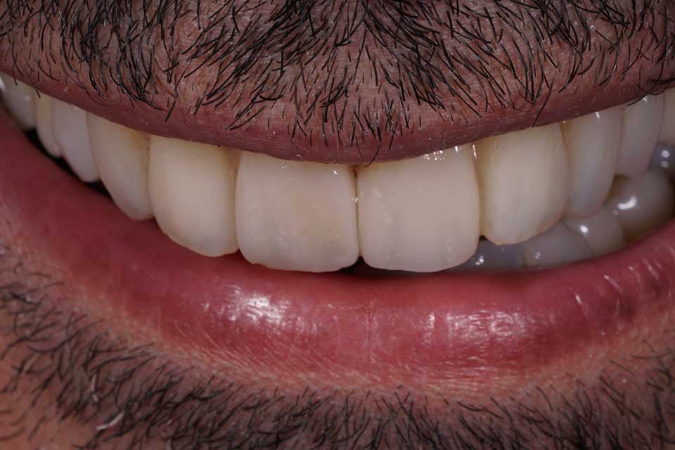5-prosthodontics-vs-orthodontics