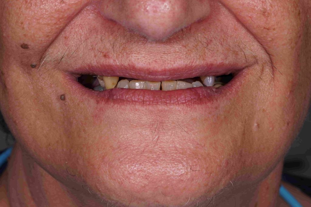 kiniti_prosthetiki_me_odontostoichia1-1024x683