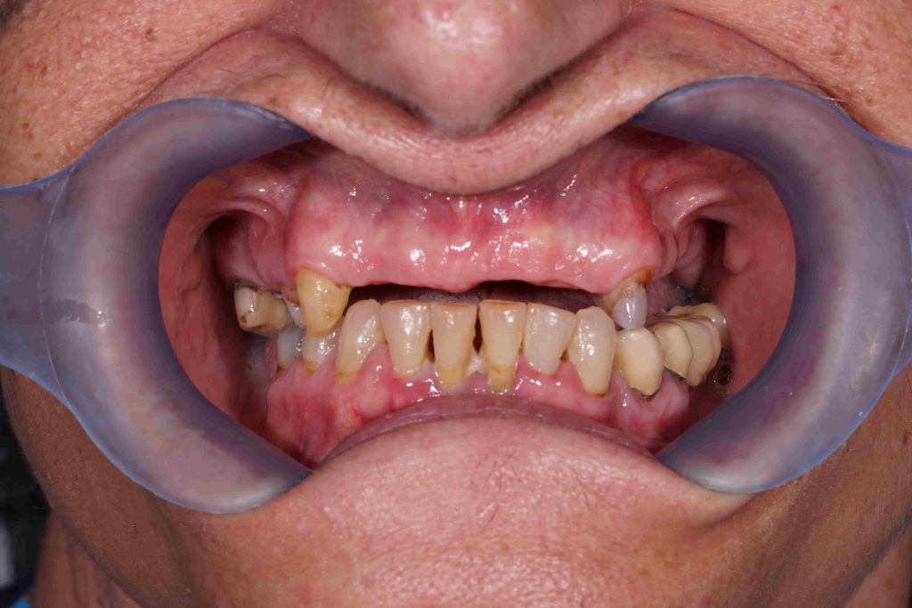 kiniti_prosthetiki_me_odontostoichia2-1024x683