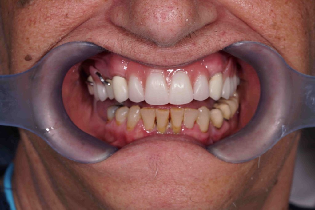 kiniti_prosthetiki_me_odontostoichia3-1024x683