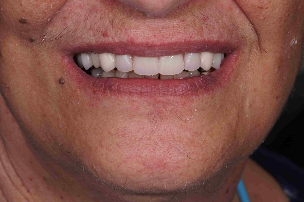 kiniti_prosthetiki_me_odontostoichia4-1024x683