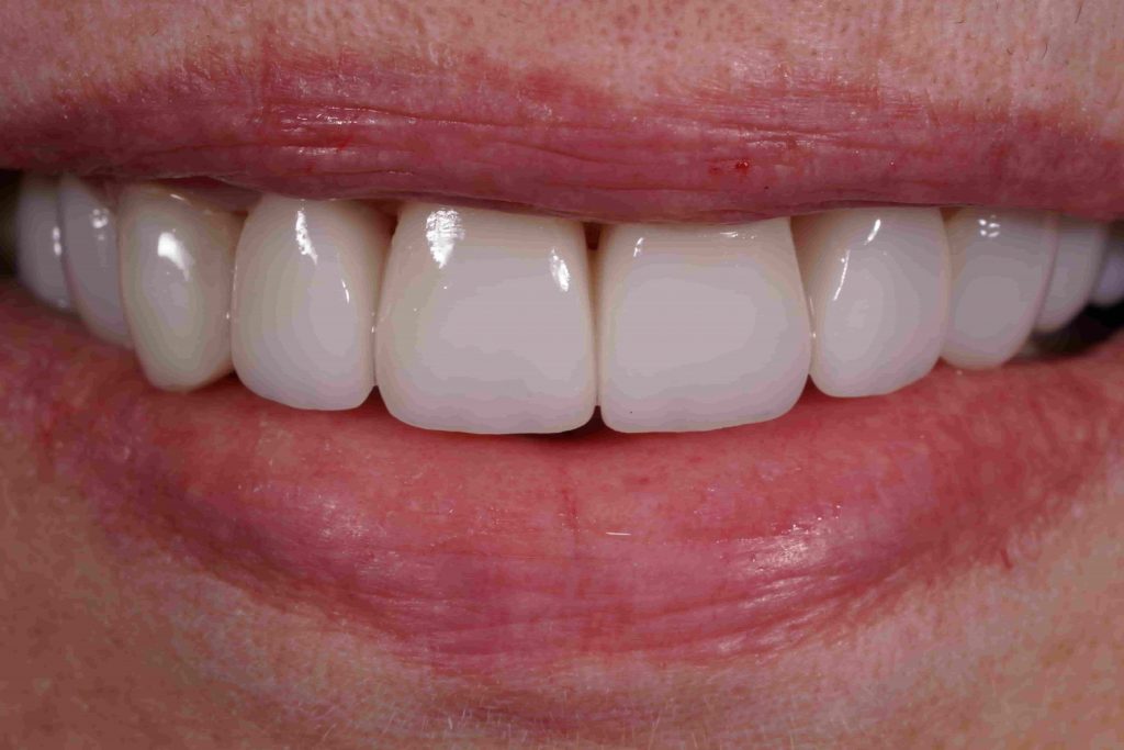 olokeramikes-thikes-emax-sta-ano-prosthia-2-1024x683