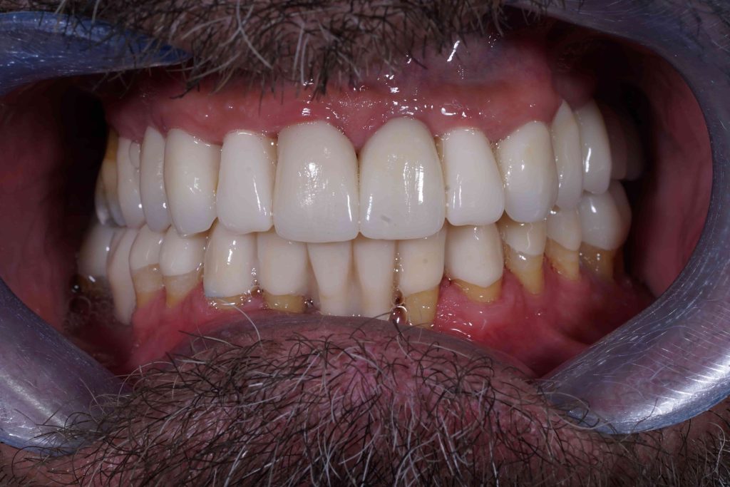 periodontitida__prosthetiki_choris_emfyteymata_2-1024x683