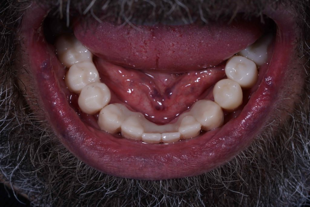 periodontitida__prosthetiki_choris_emfyteymata_3-1024x683