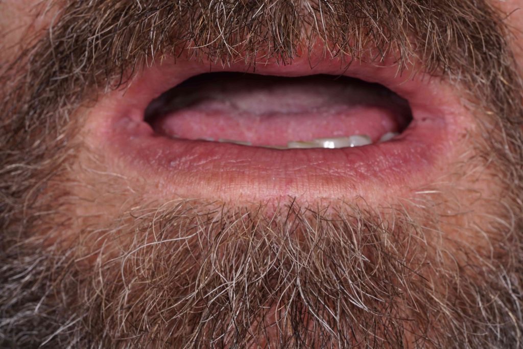 periodontitida__prosthetiki_choris_emfyteymata_5-1024x683