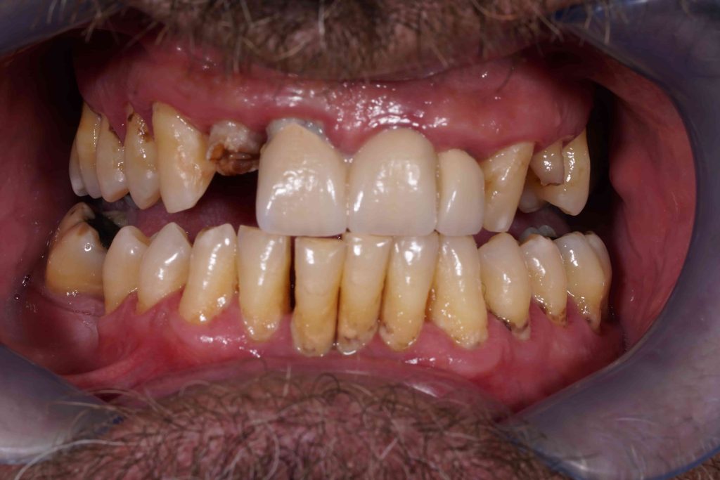 periodontitida__prosthetiki_choris_emfyteymata_6-1024x683