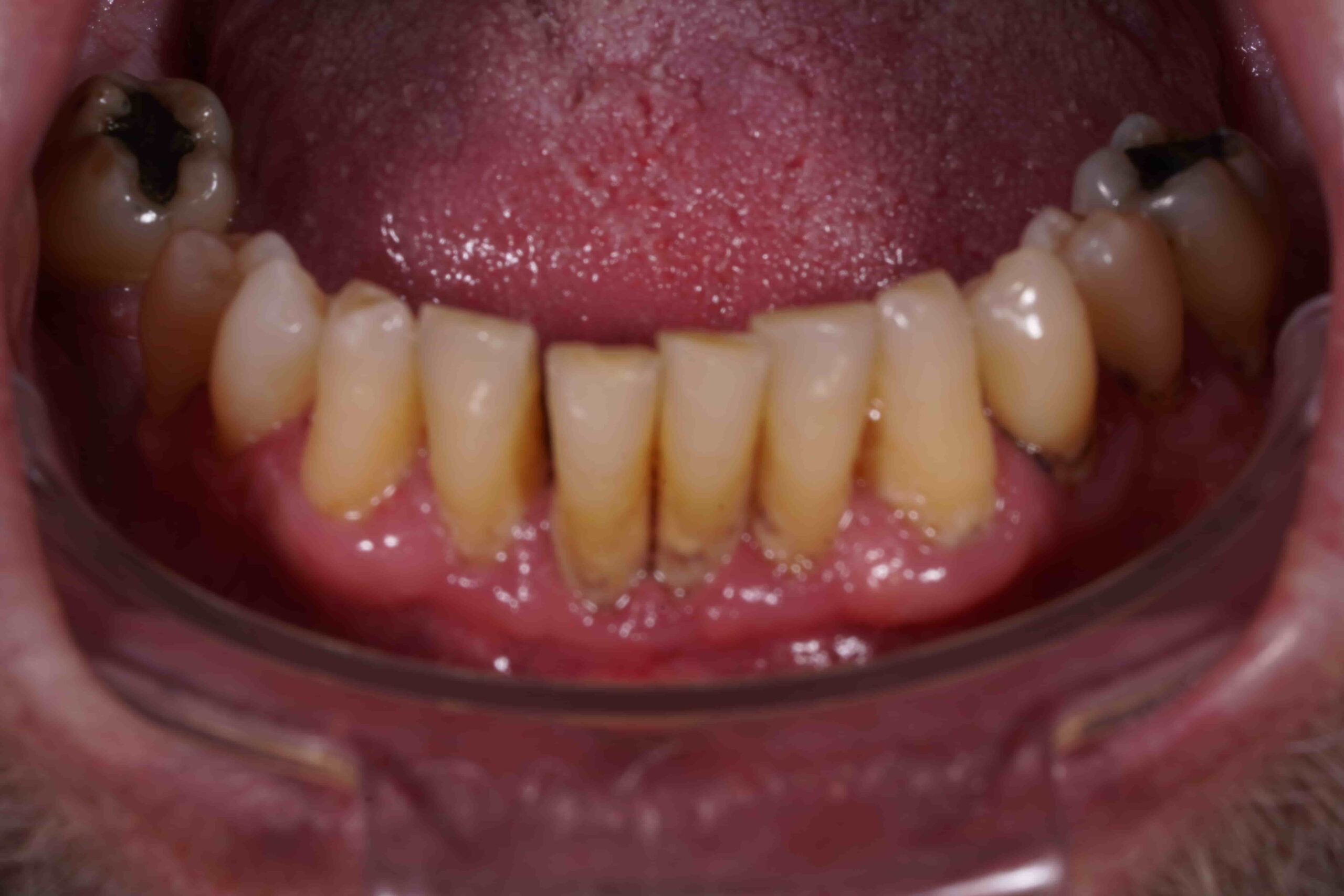 periodontitida__prosthetiki_choris_emfyteymata_7
